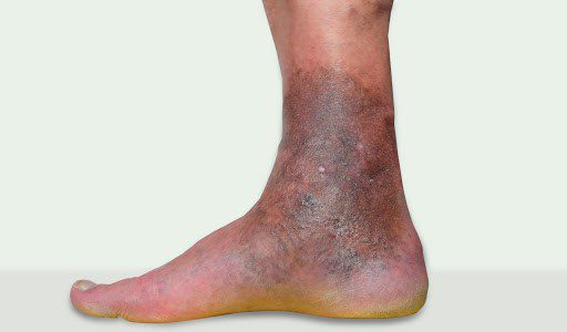Điều trị giãn tĩnh mạch chân