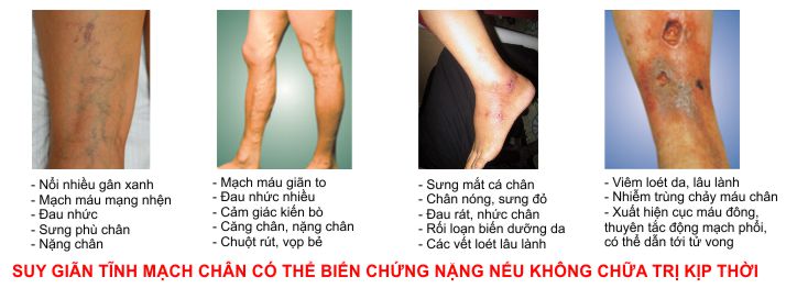 Thuốc giãn tĩnh mạch chân