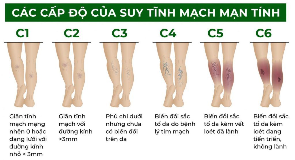 Trị giãn tĩnh mạch chân