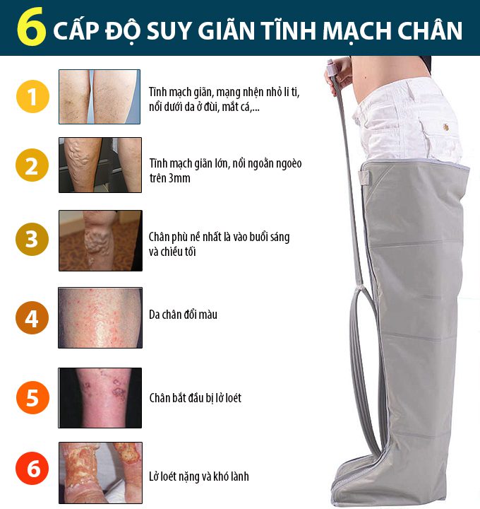 Điều trị giãn tĩnh mạch chân