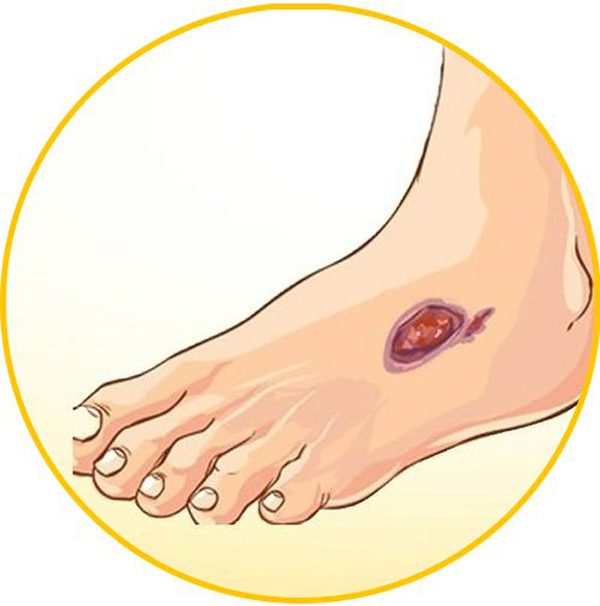 Trị giãn tĩnh mạch chân
