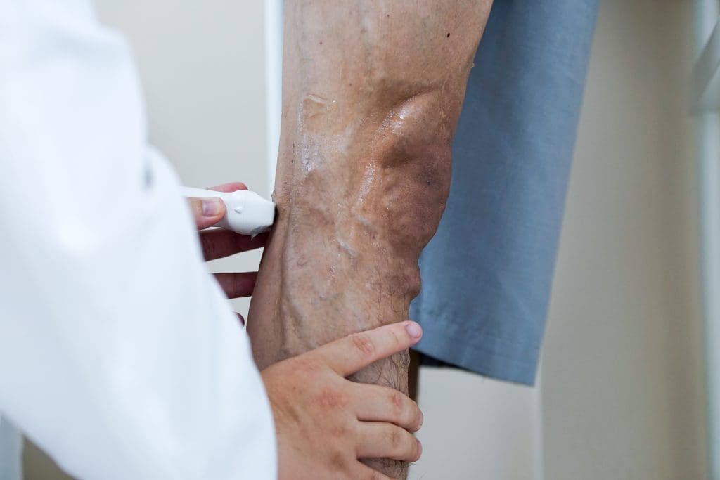 Giãn tĩnh mạch tái phát sau điều trị: 5 Nguyên nhân thật sự và cách điều trị hiệu quả gian-tinh-mach-tai-phat