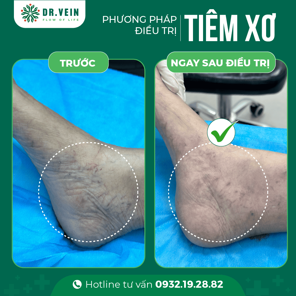 Tiêm-xơ-điều-trị-giãn-tĩnh-mạch-mắt-cá-chân-2