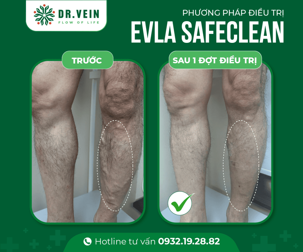 241025 EVLA SAFECLEAN 2 Web