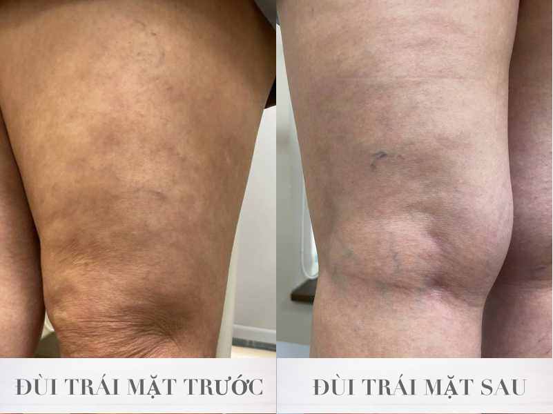 Suy tĩnh mạch mức độ 1 kèm thoái hóa cột sống, viêm khớp suy tinh mach muc do 1 2