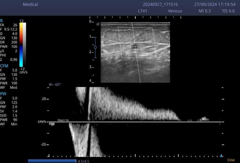 Suy giãn tĩnh mạch độ 3 dù chân không nổi gân xanh, tím suy gian tinh mach do 3 2