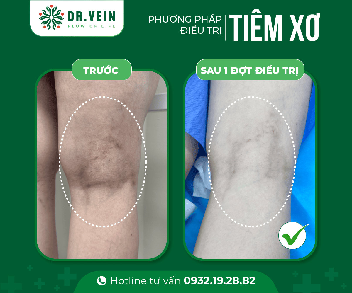 Hiệu quả tức thì SCLASER cho bệnh nhân suy giãn tĩnh mạch C1 Hieu-qua-tuc-thi-SCLASER-05