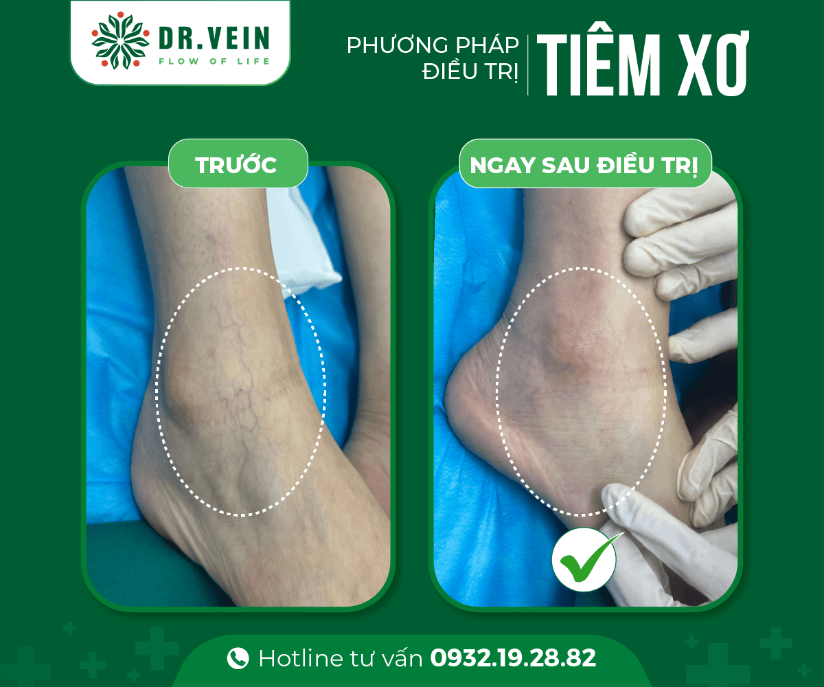 Hiệu quả tức thì SCLASER cho bệnh nhân suy giãn tĩnh mạch C1 Hieu-qua-tuc-thi-SCLASER-01