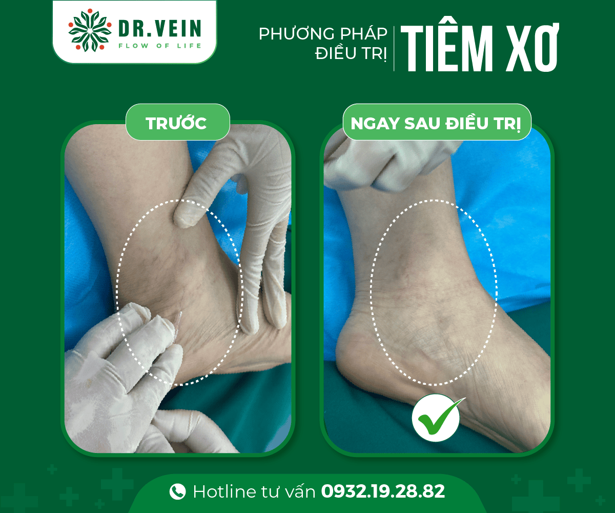Hiệu quả tức thì SCLASER cho bệnh nhân suy giãn tĩnh mạch C1 Hieu-qua-tuc-thi-SCLASER-02