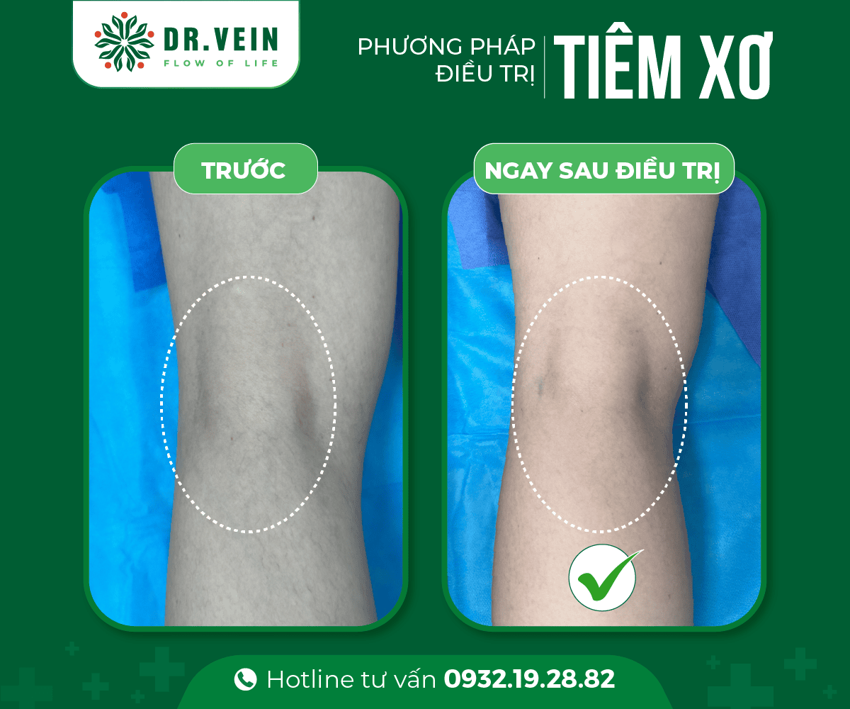 Hiệu quả tức thì SCLASER cho bệnh nhân suy giãn tĩnh mạch C1 Hieu-qua-tuc-thi-SCLASER-03