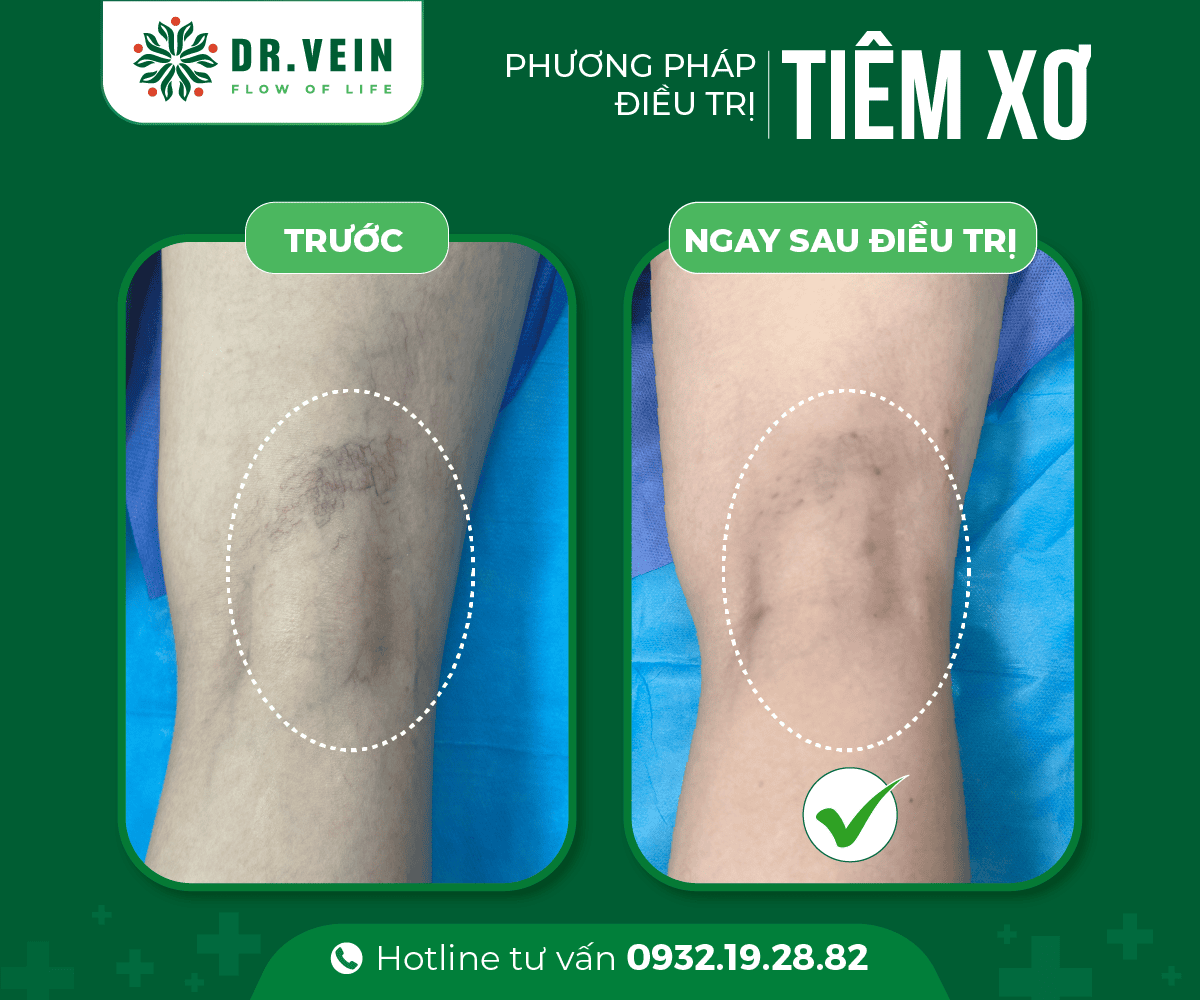 Hiệu quả tức thì SCLASER cho bệnh nhân suy giãn tĩnh mạch C1 Hieu-qua-tuc-thi-SCLASER-04