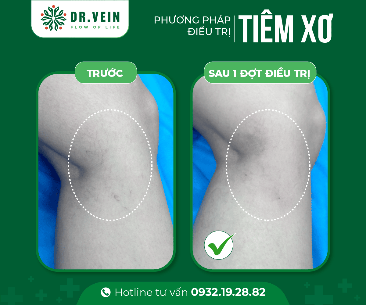 Hiệu quả tức thì SCLASER cho bệnh nhân suy giãn tĩnh mạch C1 Hieu-qua-tuc-thi-SCLASER-06