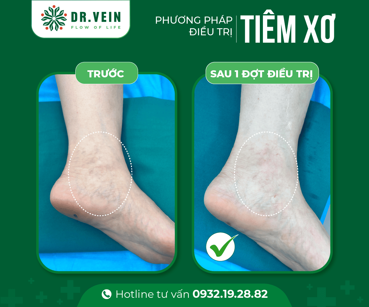 Hiệu quả tức thì SCLASER cho bệnh nhân suy giãn tĩnh mạch C1 Hieu-qua-tuc-thi-SCLASER-07