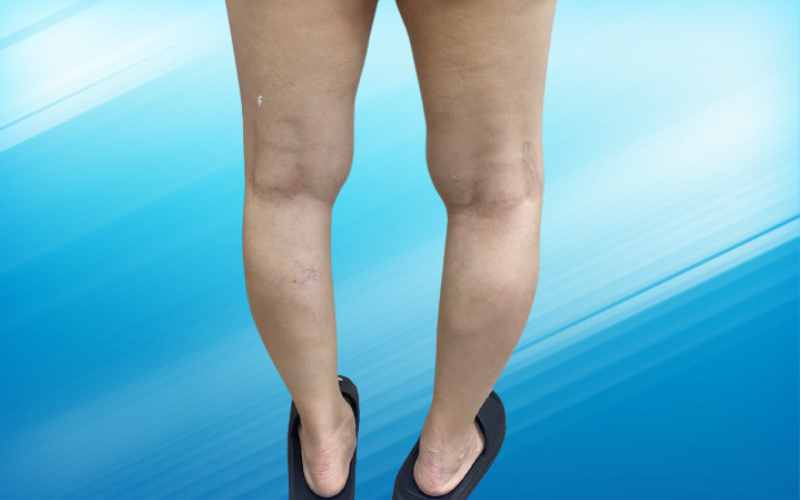8 năm điều trị suy giãn tĩnh mạch: 2 bệnh viện, 2 kết quả 