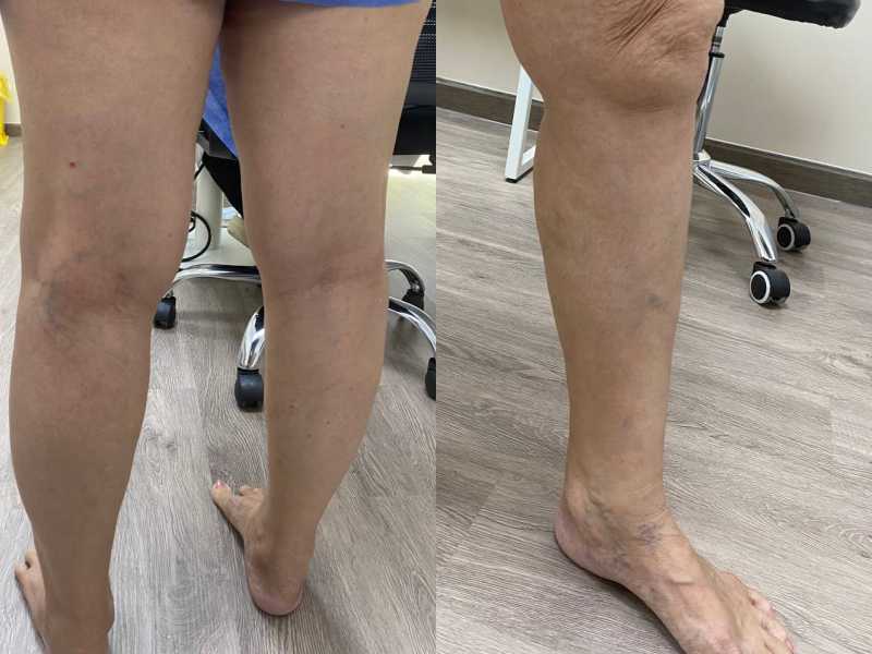Chẩn đoán huyết khối tĩnh mạch sâu mãn tính: Điều trị ra sao? Chẩn đoán huyết khối tĩnh mạch sâu mãn tính: Điều trị ra sao?