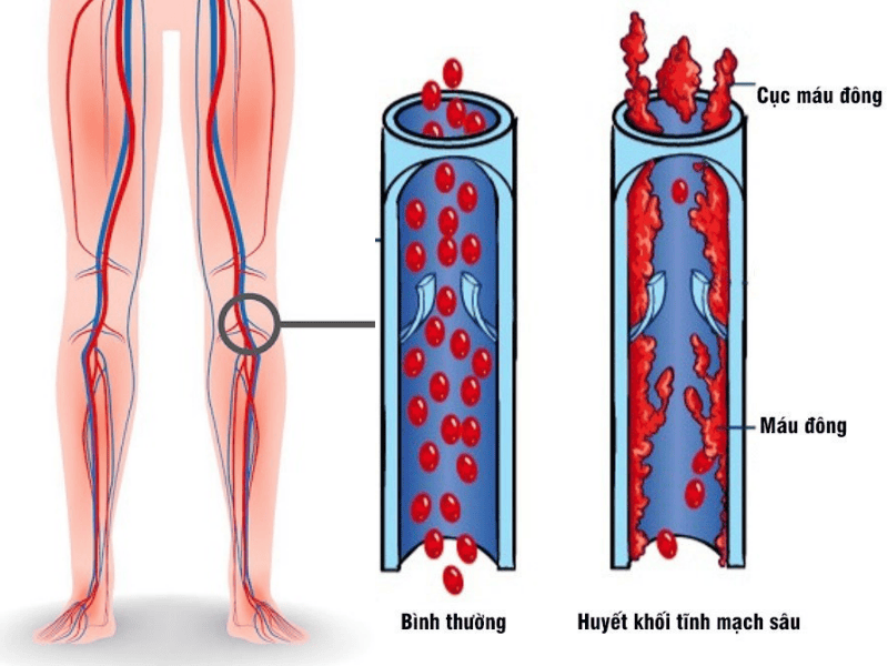 Chẩn đoán huyết khối tĩnh mạch sâu mãn tính: Điều trị ra sao? Chẩn đoán huyết khối tĩnh mạch sâu mãn tính: Điều trị ra sao?