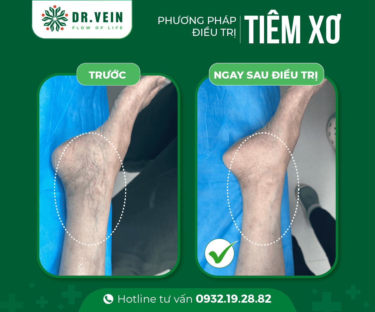 Dieu-tri-SCLASER-cho-tinh-mach-dang-luoi-01