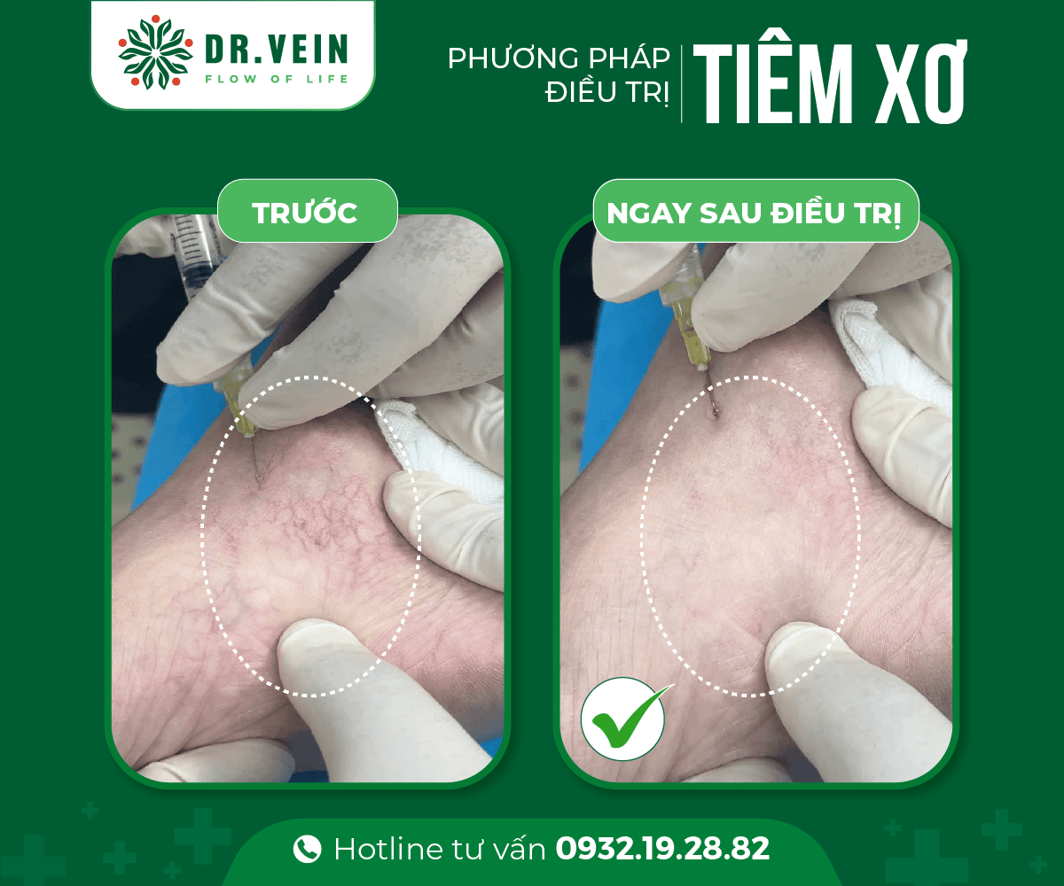 Dieu-tri-SCLASER-cho-tinh-mach-dang-luoi-02