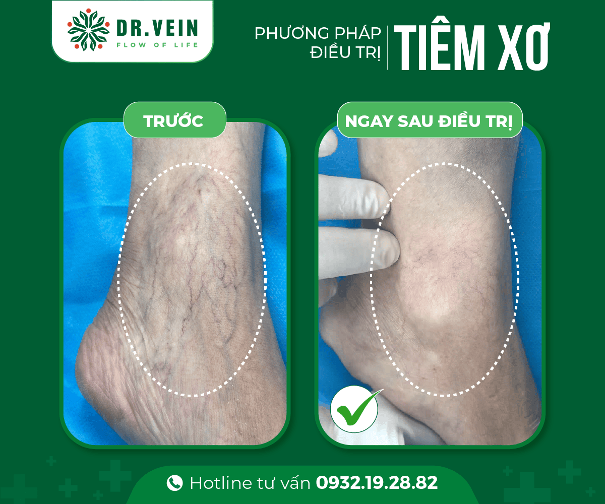 Dieu-tri-SCLASER-cho-tinh-mach-dang-luoi-03