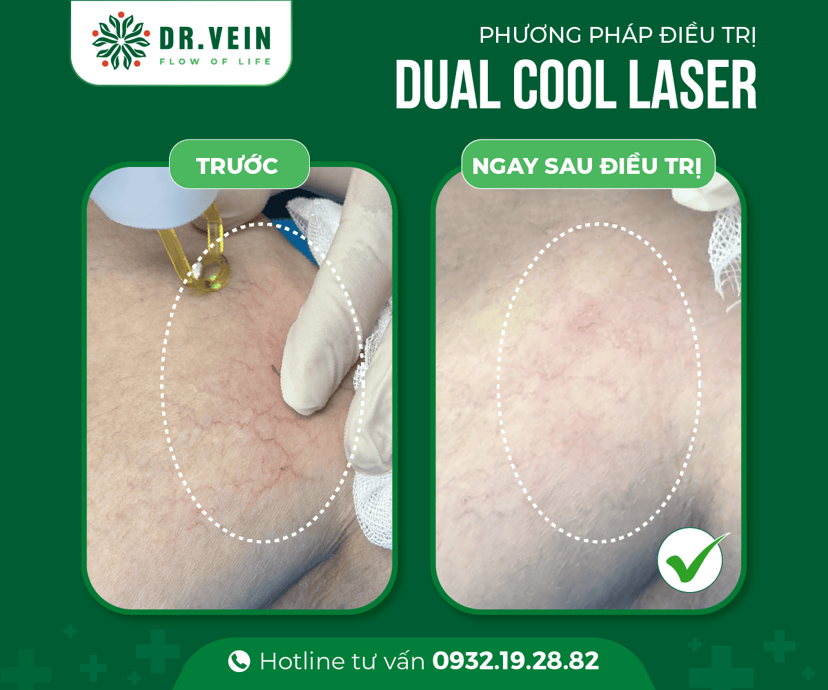 Dieu-tri-SCLASER-cho-tinh-mach-dang-luoi-04