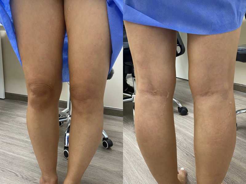 Suy giãn tĩnh mạch độ 3 dù chân không nổi gân xanh, tím suy gian tinh mach do 3 1