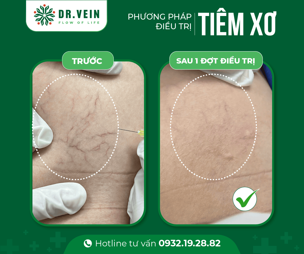 Gân xanh đỏ mạng nhện "mất sạch" sau khi Tiêm xơ Bui Thanh Trang 1 Web