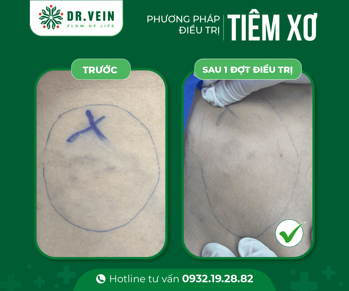 Gân xanh đỏ mạng nhện "mất sạch" sau khi Tiêm xơ Bui Thanh Trang 2 web