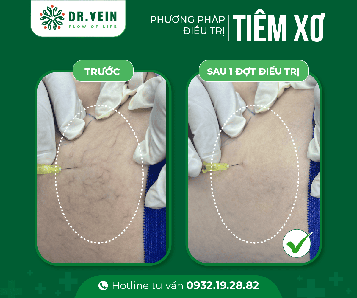 Gân xanh đỏ mạng nhện "mất sạch" sau khi Tiêm xơ Bui Thanh Trang 3 Web