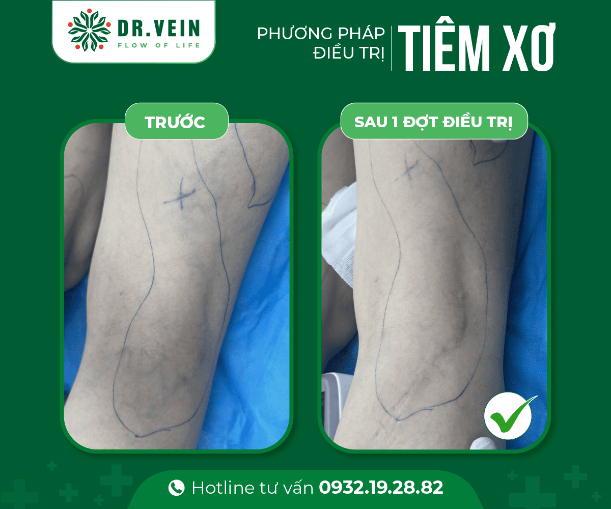 Gân xanh đỏ mạng nhện "mất sạch" sau khi Tiêm xơ Bui Thanh Trang 4 Web