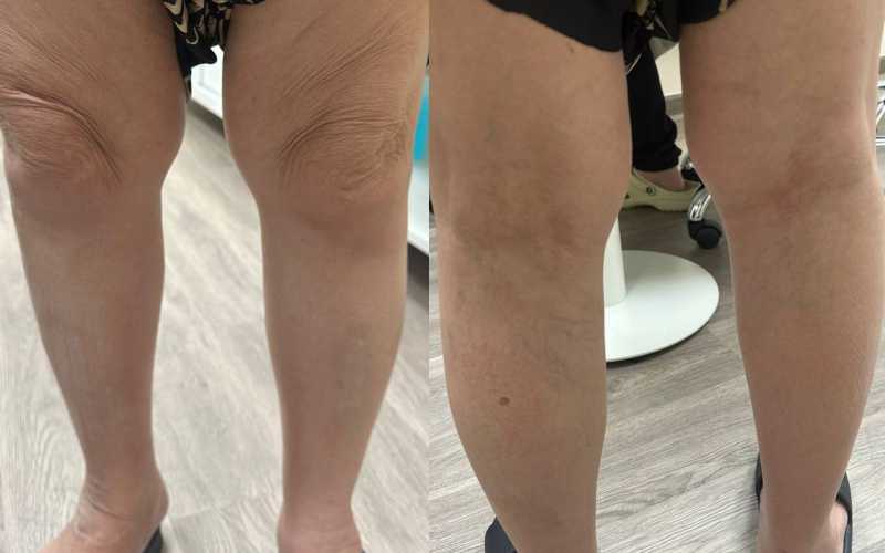 Điều trị giãn tĩnh mạch thất bại: Do thoái hóa khớp gây ra? Điều trị giãn tĩnh mạch thất bại: Do thoái hóa khớp gây ra?