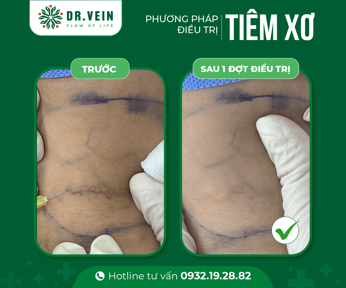 Hình ảnh trước - sau điều trị bằng phương pháp Tiêm xơ 