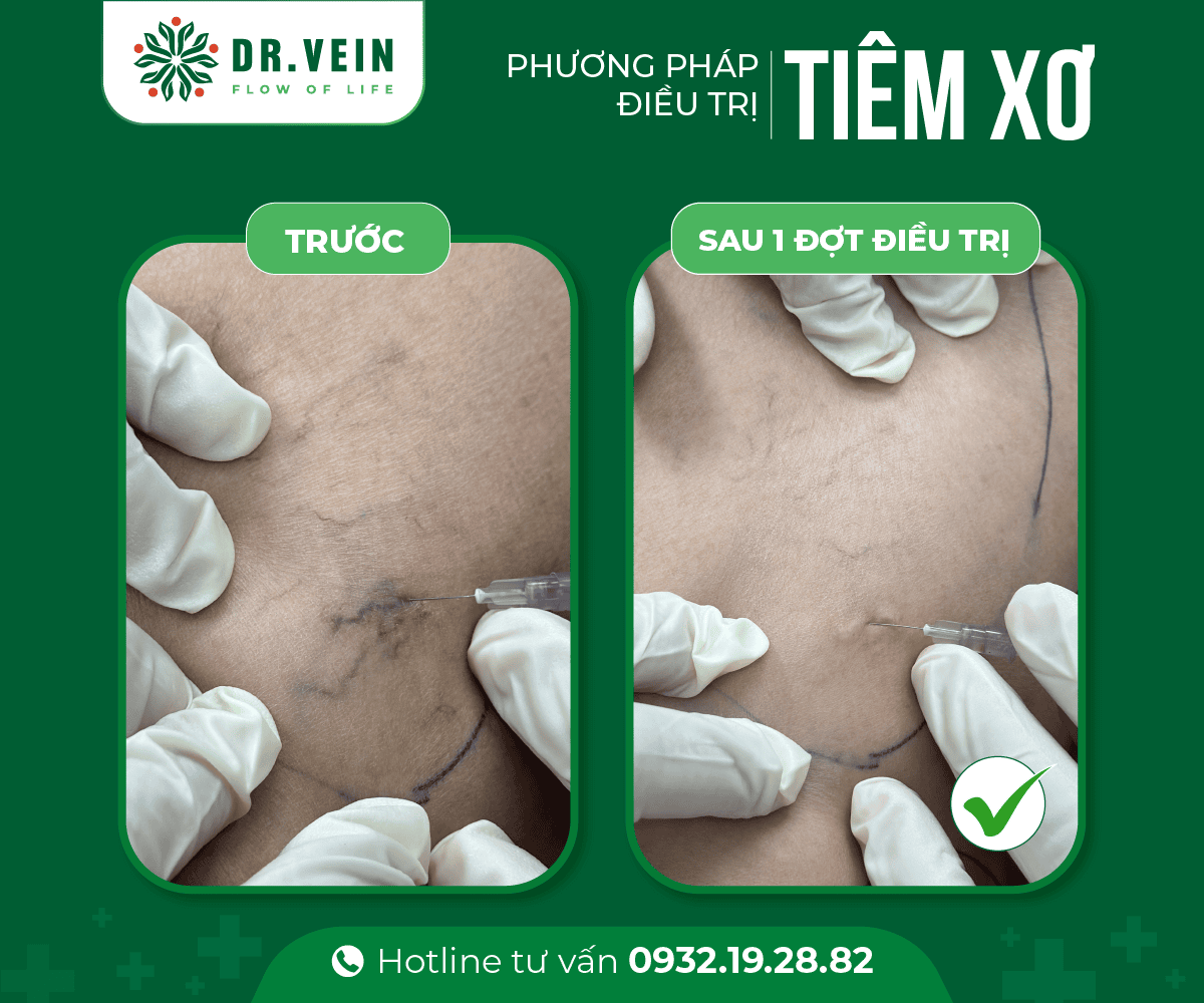 Hình ảnh trước - sau điều trị bằng phương pháp Tiêm xơ 