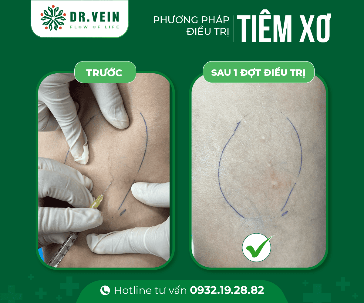Hình ảnh trước - sau điều trị bằng phương pháp Tiêm xơ 