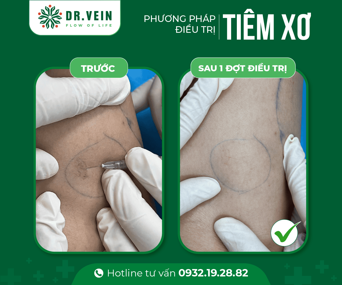 Hình ảnh trước - sau điều trị bằng phương pháp Tiêm xơ 