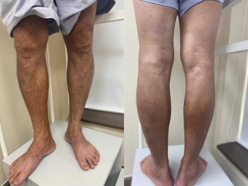 Huyết khối tĩnh mạch khoeo kèm suy giãn: Điều trị thế nào? Huyết khối tĩnh mạch khoeo kèm suy giãn: Điều trị thế nào?