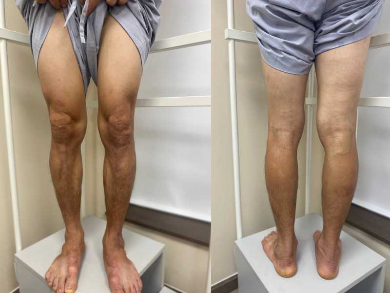 Suy tĩnh mạch chi dưới ẩn giấu, chẩn đoán C2 cần can thiệp Suy tĩnh mạch chi dưới ẩn giấu, chẩn đoán C2 cần can thiệp