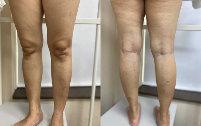 Thuốc tĩnh mạch không hiệu quả, bác sĩ khuyên điều trị bảo tồn Thuốc tĩnh mạch không hiệu quả, bác sĩ khuyên điều trị bảo tồn