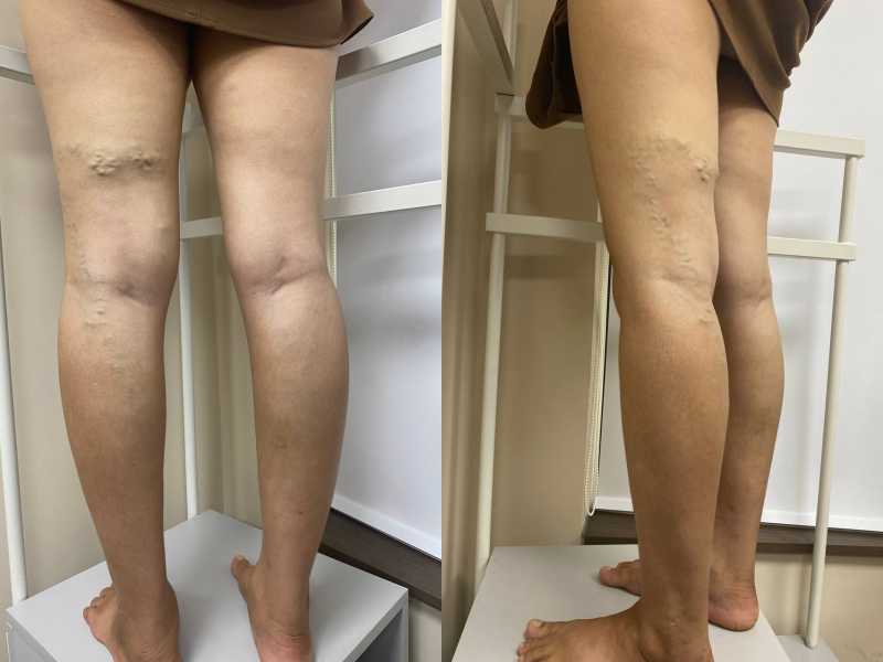 Suy tĩnh mạch C2 cần can thiệp: Phù chân nặng sau 3 lần sinh con Suy tĩnh mạch C2 cần can thiệp: Phù chân nặng sau 3 lần sinh con