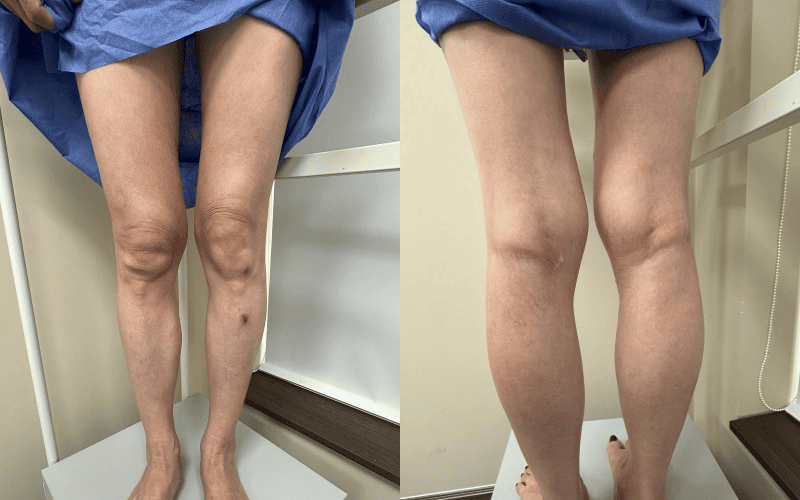 Điều trị suy giãn tĩnh mạch bằng laser nhưng vẫn đau mỏi 