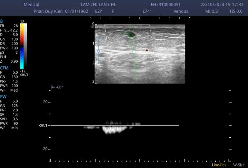 Điều trị suy giãn tĩnh mạch bằng laser nhưng vẫn đau mỏi 