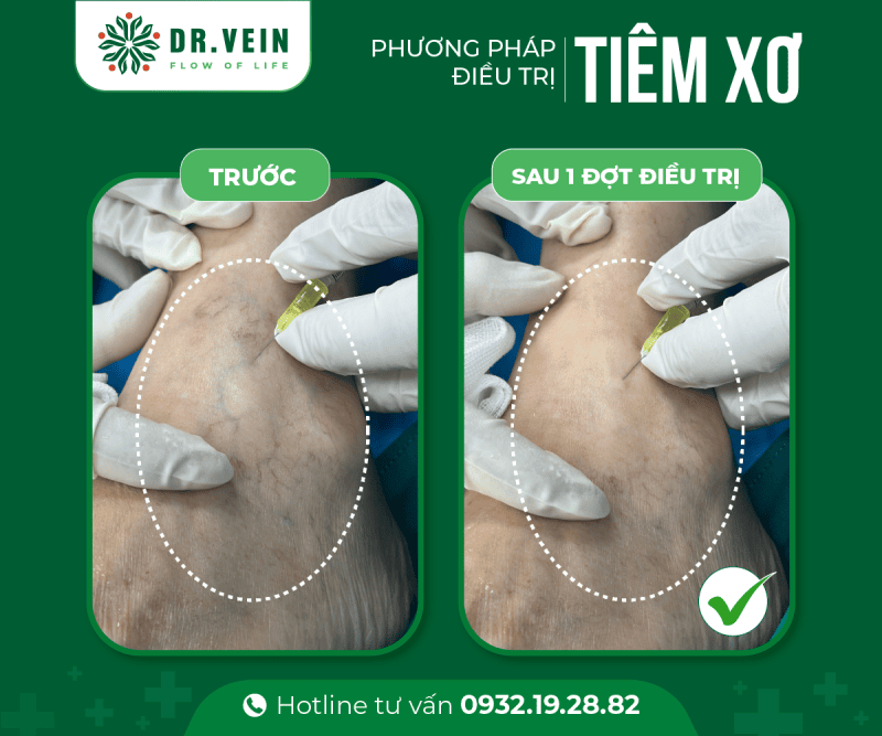Điều trị suy giãn tĩnh mạch bằng laser nhưng vẫn đau mỏi 