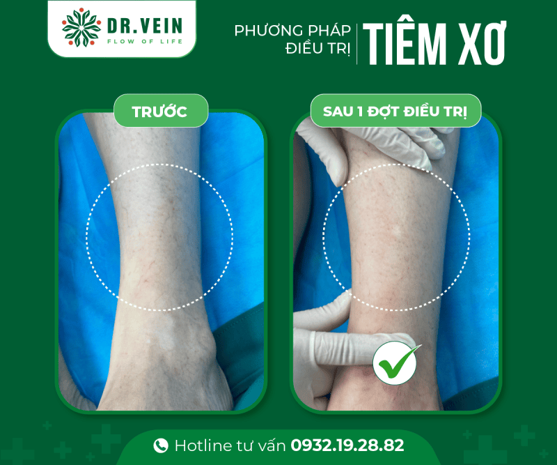 Điều trị suy giãn tĩnh mạch bằng laser nhưng vẫn đau mỏi 