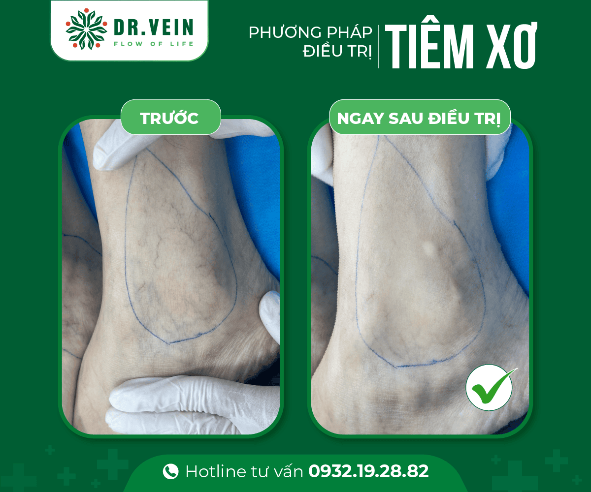 Tiêm xơ bổ sung hoàn thiện liệu trình điều trị gân xanh tiem-xo-bo-sung