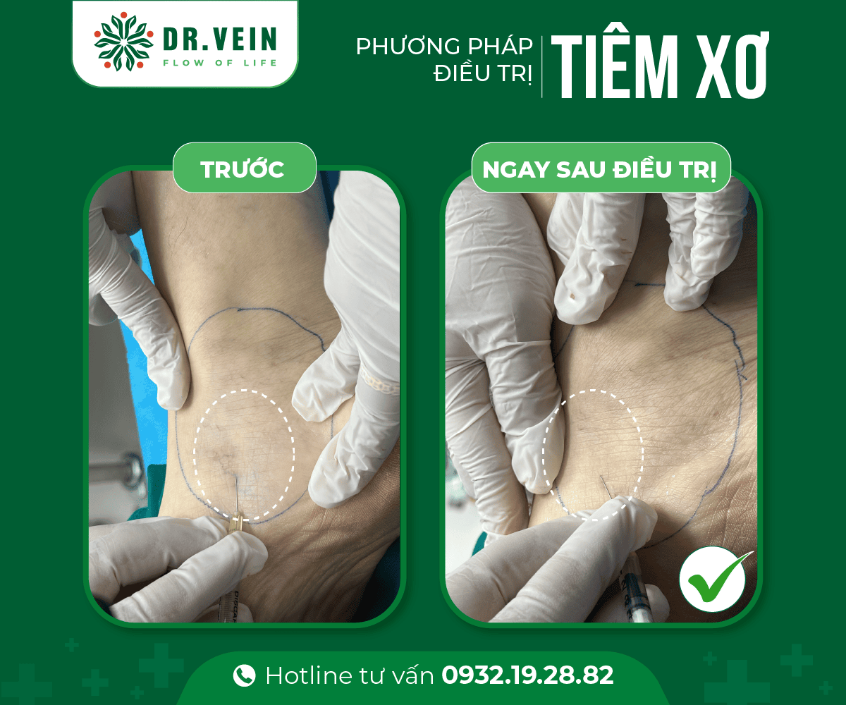 Tiêm xơ bổ sung hoàn thiện liệu trình điều trị gân xanh tiem-xo-bo-sung-01