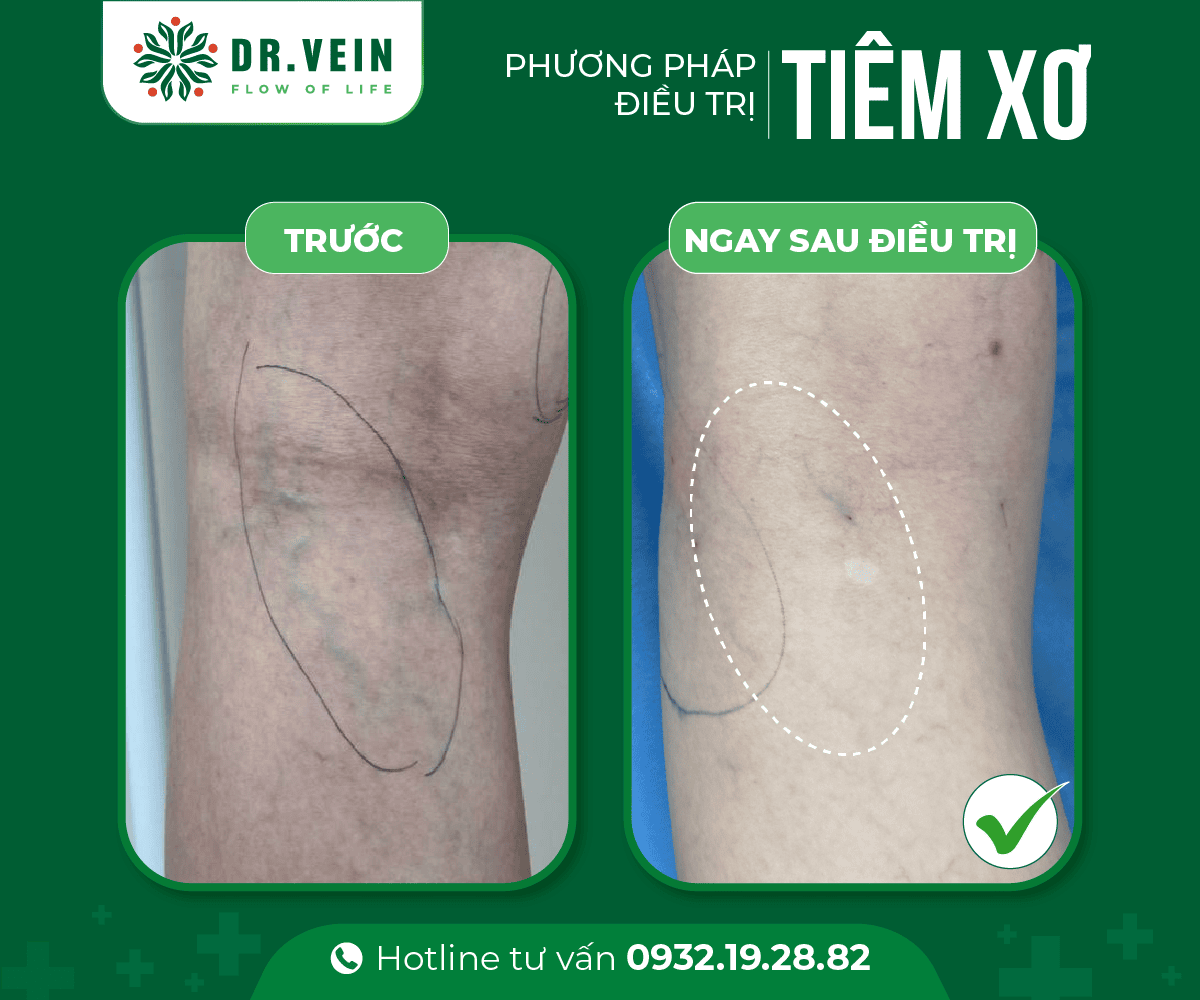 Tiêm xơ bổ sung hoàn thiện liệu trình điều trị gân xanh tiem-xo-bo-sung-02