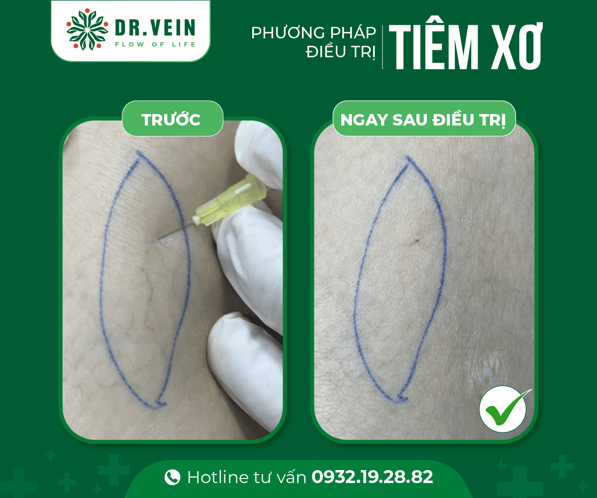 Tiêm xơ bổ sung hoàn thiện liệu trình điều trị gân xanh tiem-xo-bo-sung-03