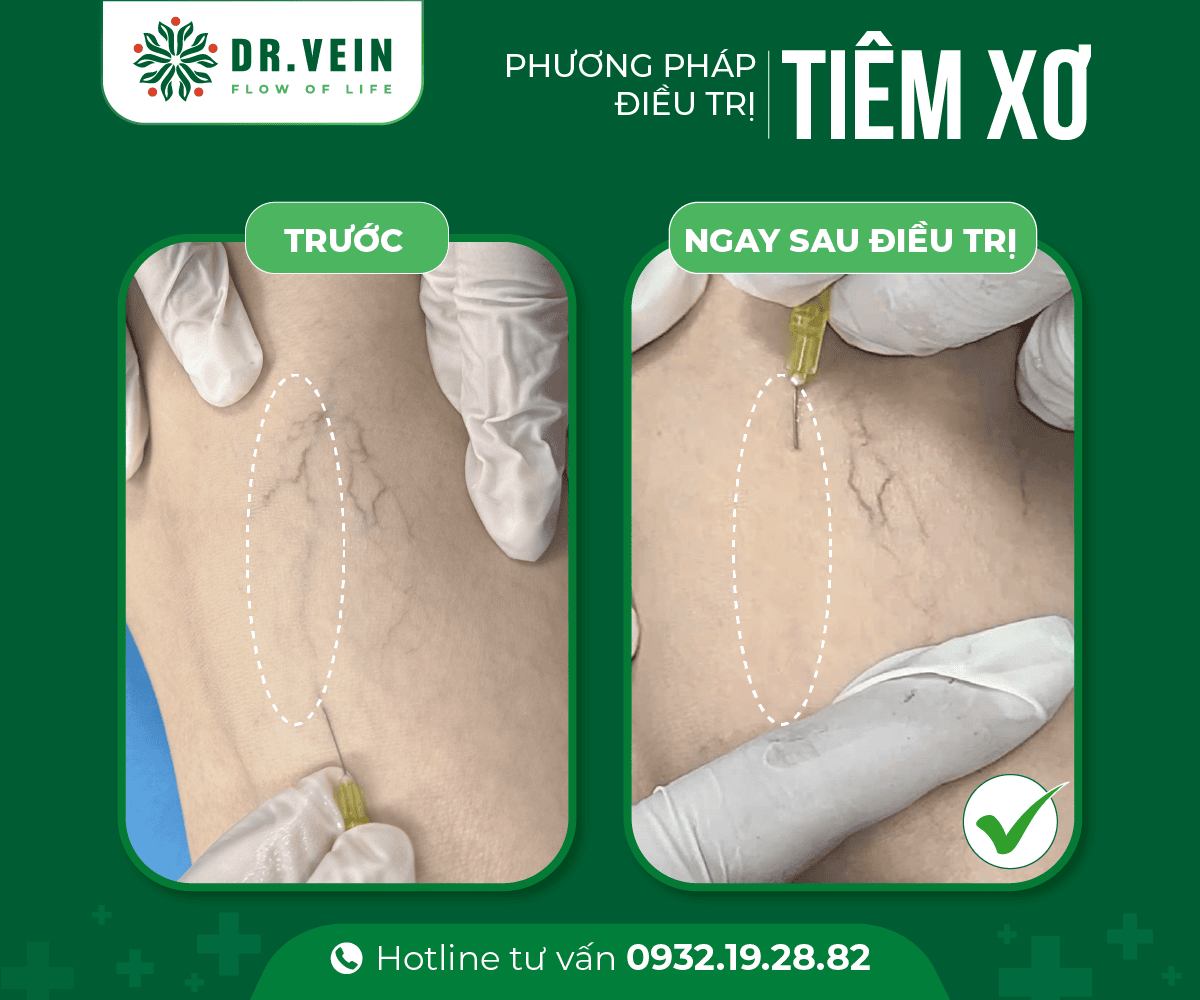 Tiêm xơ bổ sung hoàn thiện liệu trình điều trị gân xanh tiem-xo-bo-sung-04