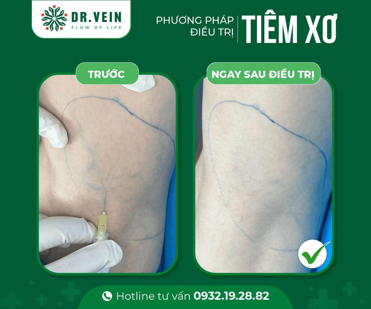 Tiêm xơ bổ sung hoàn thiện liệu trình điều trị gân xanh tiem-xo-bo-sung-05