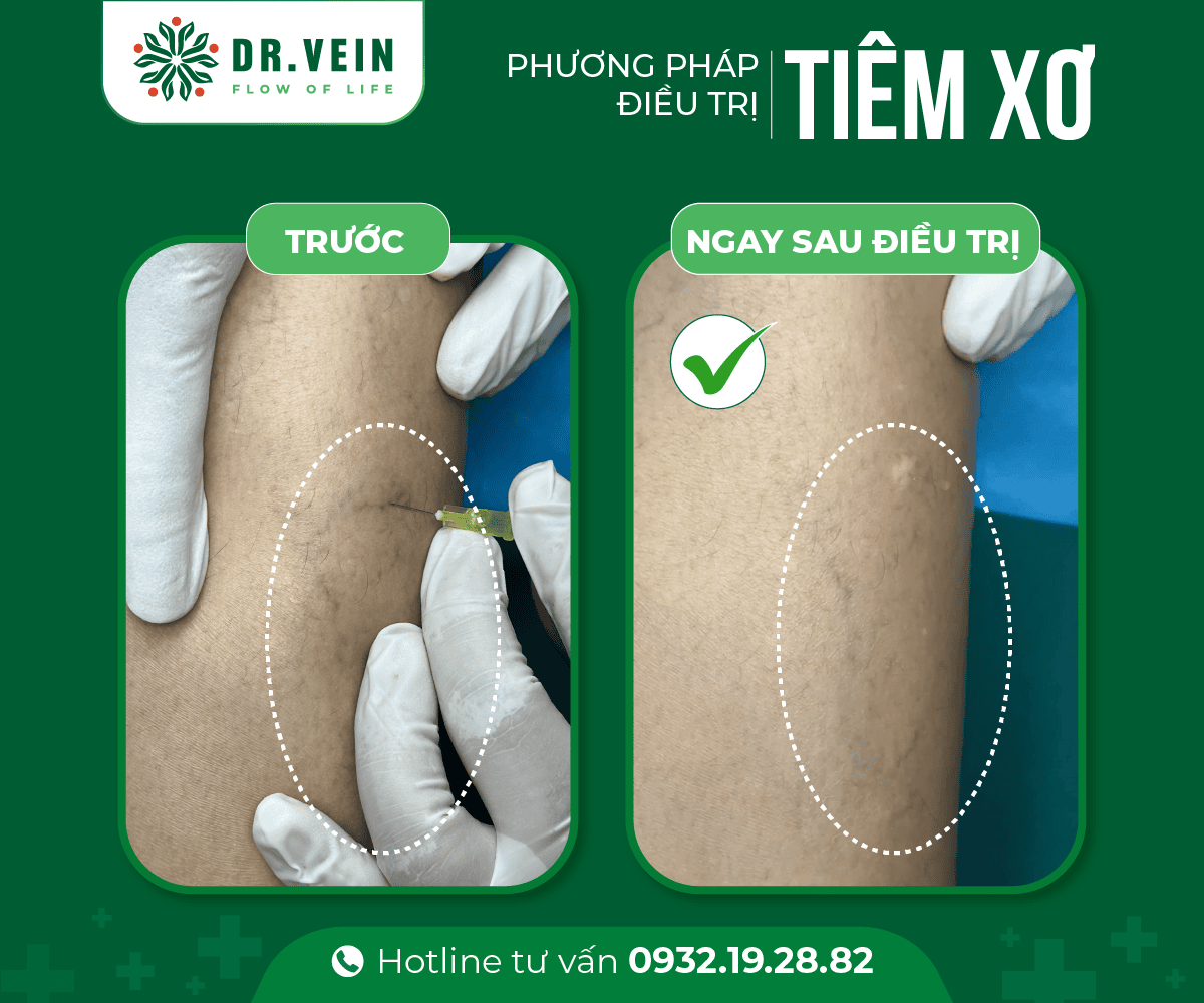 Phương pháp tiêm xơ - Hình ảnh trước & ngay sau điều trị 