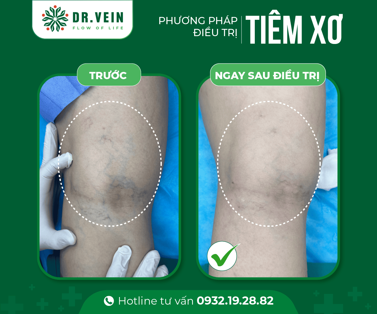 Phương pháp tiêm xơ - Hình ảnh trước & ngay sau điều trị 